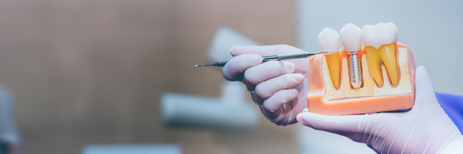 Dental Implants | Dentist